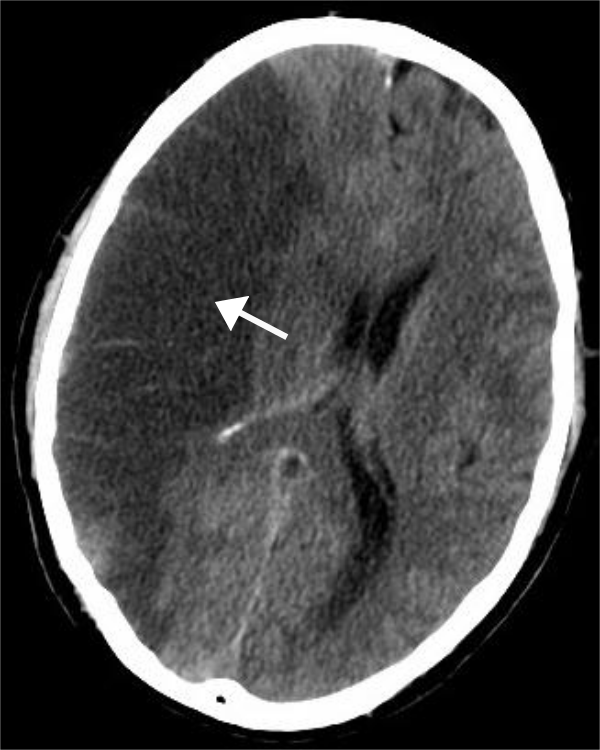 大脑的电脑断层扫描图，显示大脑右侧发生缺血性脑中风。（CT scan of the brain showing a right-hemispheric ischemic stroke.）
