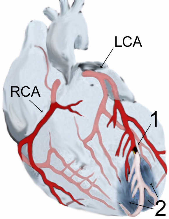 由于左冠状动脉（LCA）有一个分支堵塞（位置(1)处），造成心前壁顶端（位置(2)）梗死，图中的RCA是右冠状动脉。